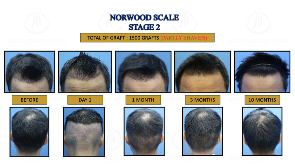 Norwood Stage 2 Hair Transplant Centre Malaysia Hair Treatment
