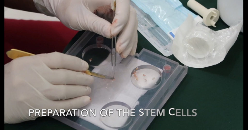 Preparation of the stem cell At Hair Transplant Centre Malaysia