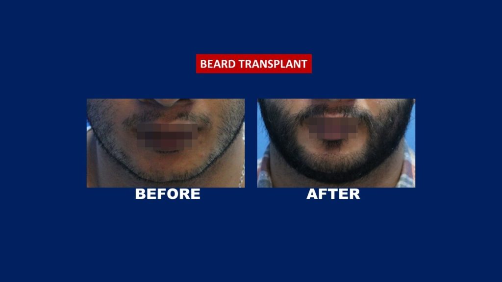 Hair Transplant Centre Malaysia Before and After Beard Transplant