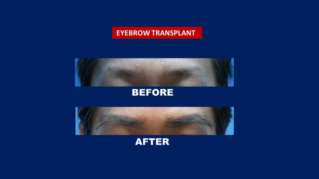 Hair Transplant Centre Malaysia, Eyebrow Transplant Before and After picture Of 1 years Results