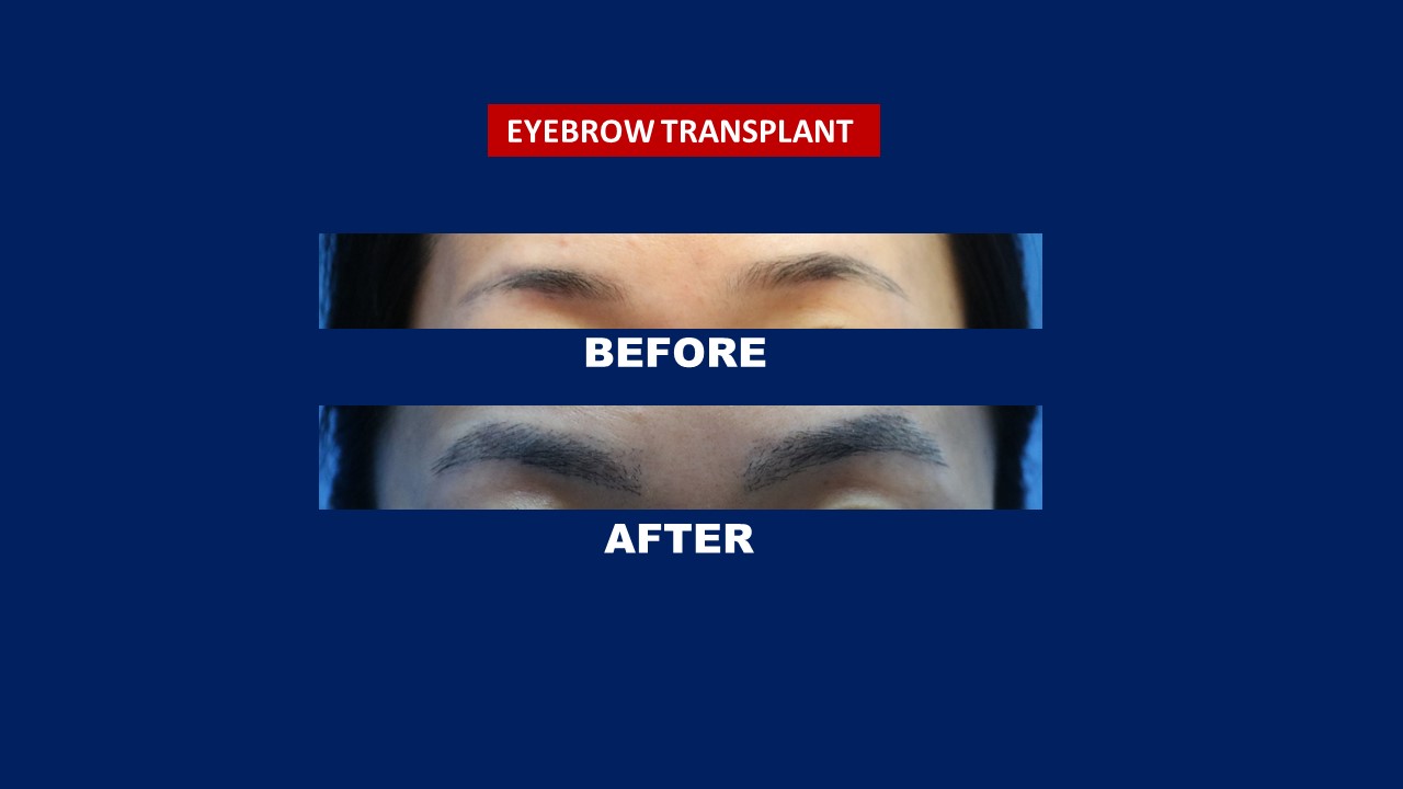 Eyebrow transplant in germany