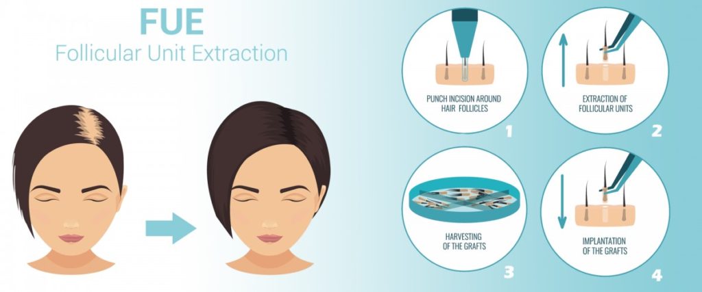 FUE Procedure Details For Female Pattern Hair Transplant