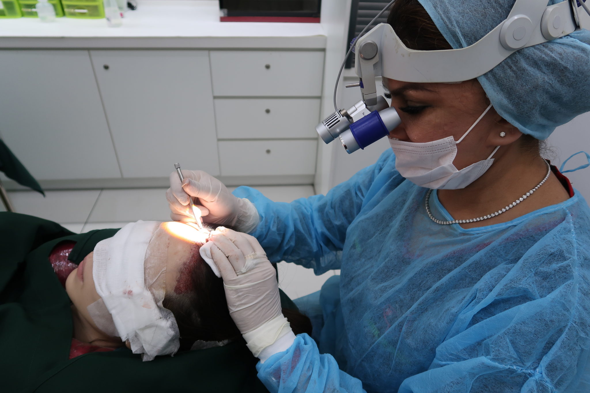 Fue Hair Transplant Procedure Lowering Hairline