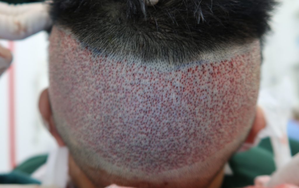 Male Donor Area for Hair Transplant at Hair Transplant Malaysia