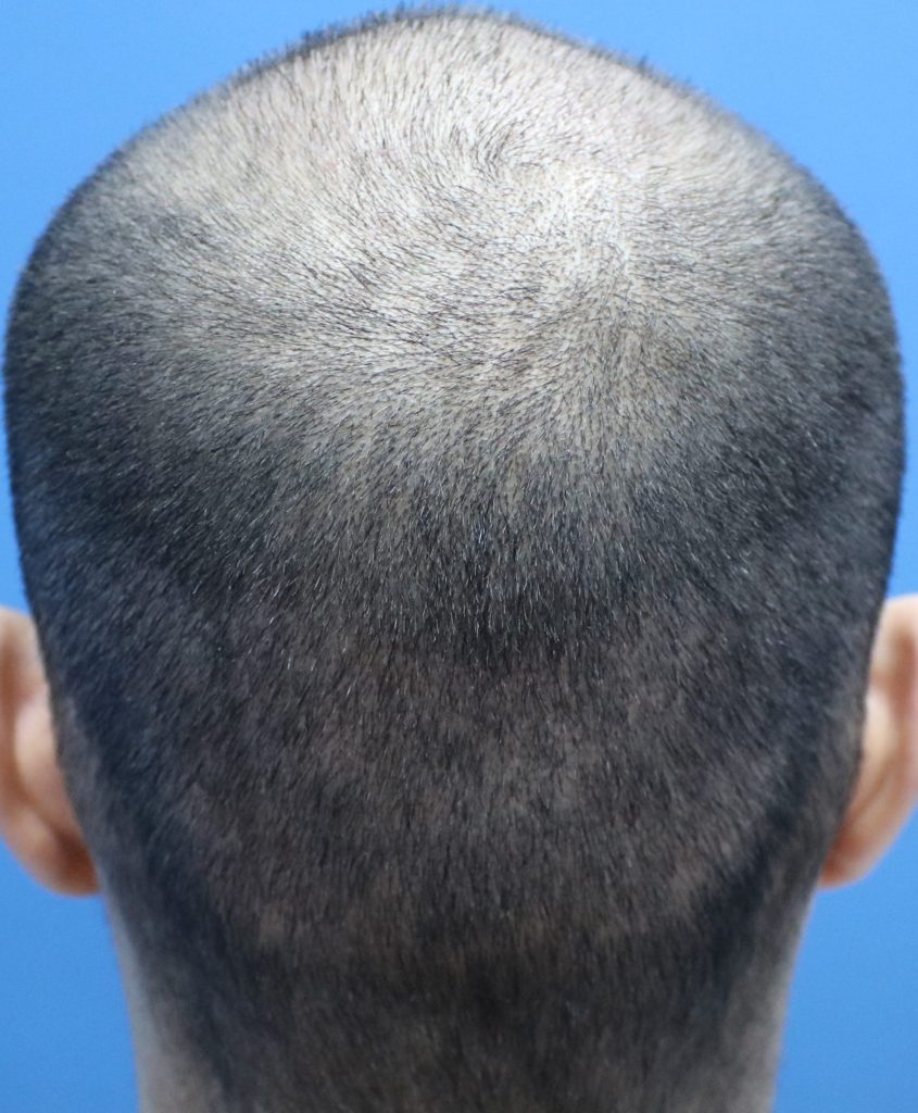 1 Week Result for Fue Male Donor Hair Transplant