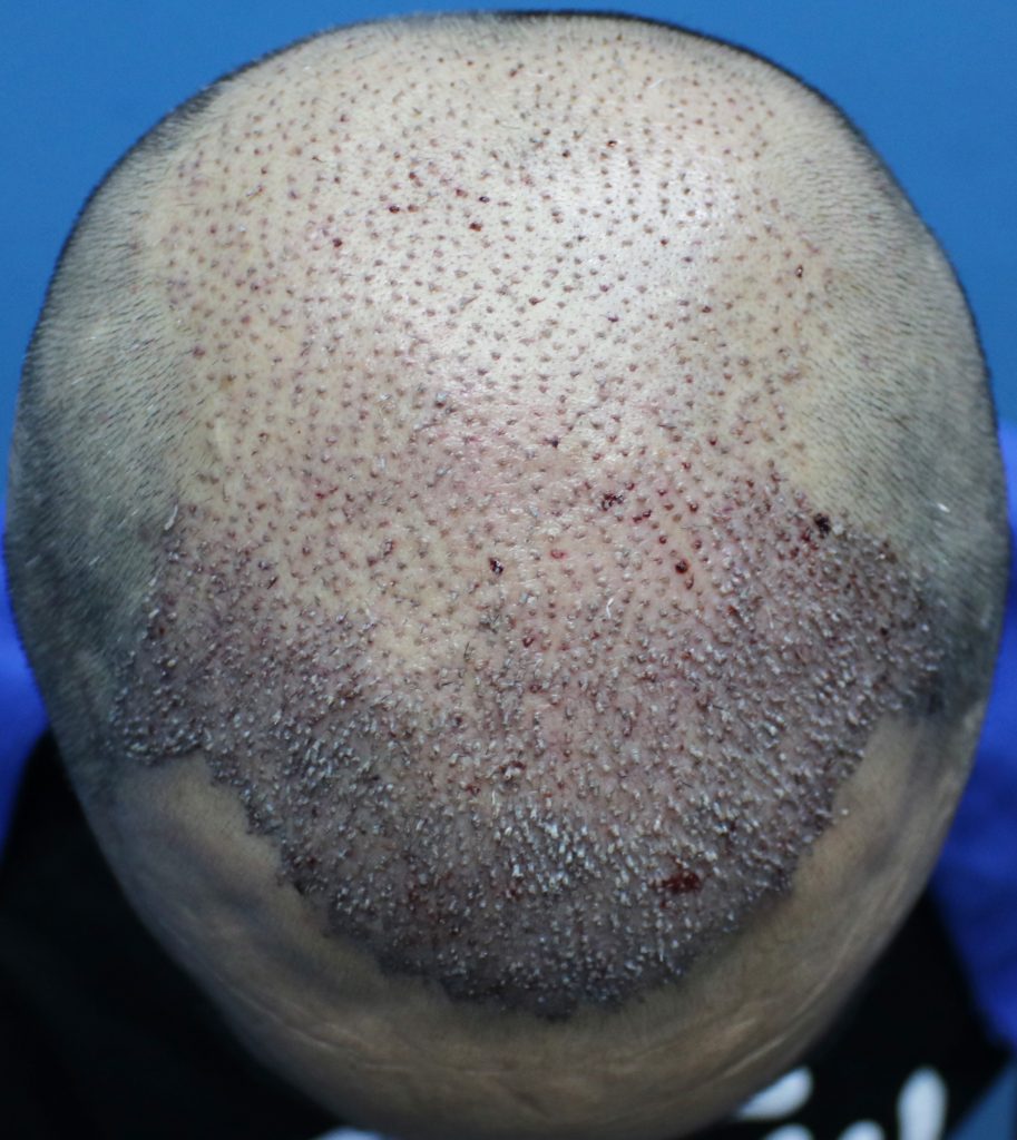 Fue Hair Transplant on Day 1