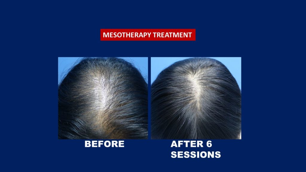 Hair Transplant Centre Malaysia. Before and after 6 session of mesotherapy hair loss treatment