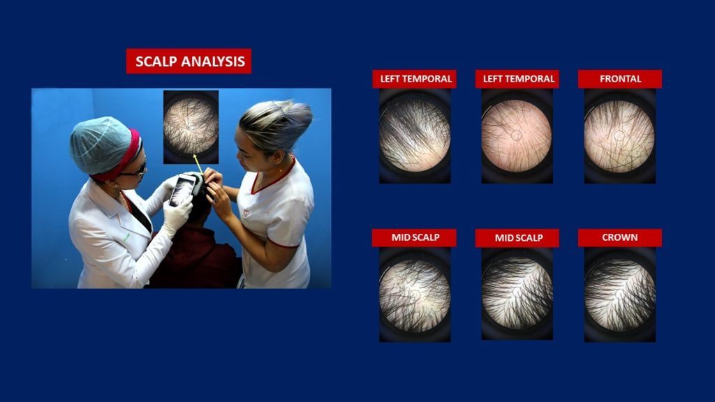 Hair Transplant Scalp Analysia