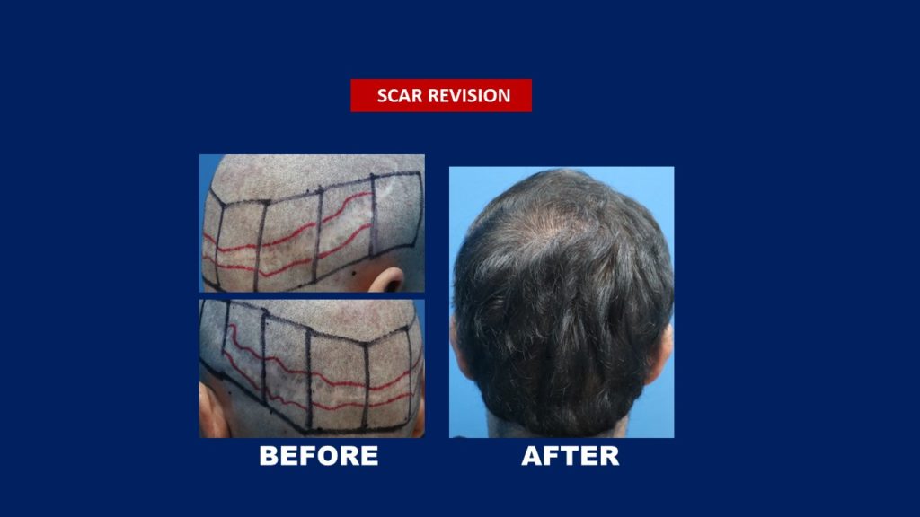 Hair Transplant Centre Malaysia Scar Revison Before and After