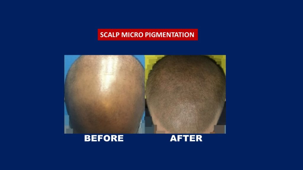 Scalp Micro Pigmentation at Hair transplant Centre Malaysia. before and after male 2 session