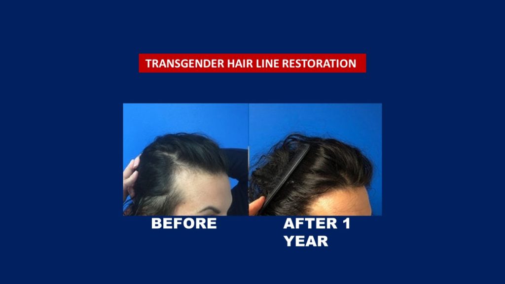 Hair Transplant Centre Malaysia, Before and After new hair line temporal