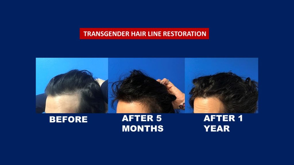 Hair Transplant Centre Malaysia, Before and After new hair line temporal 1