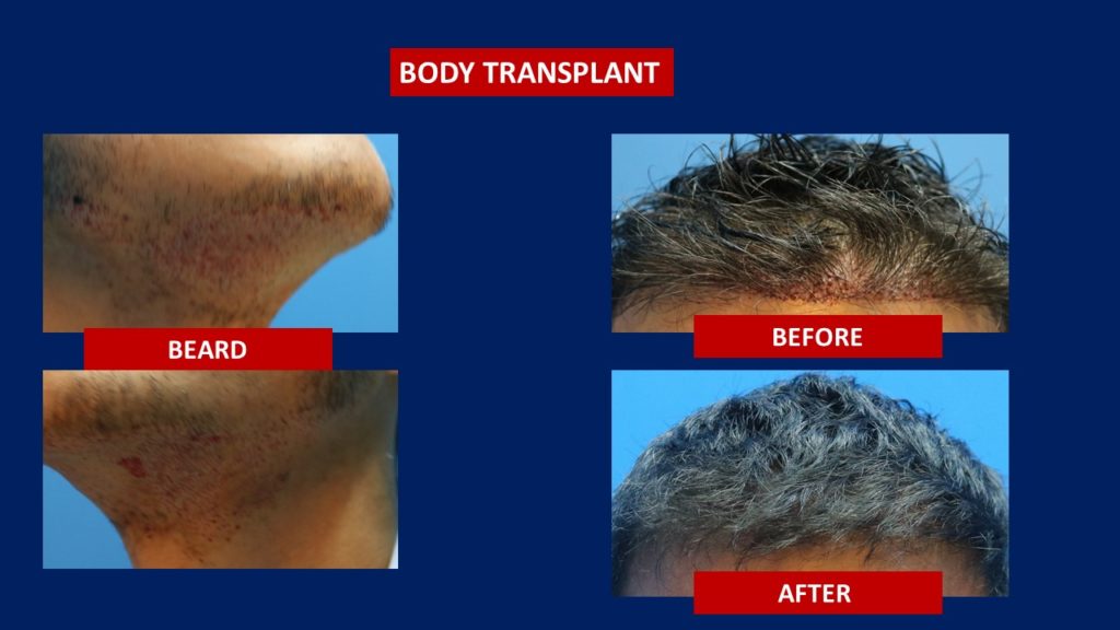 Hair Transplant Centre Malaysia, Before and After Body Transplant after 1 years results