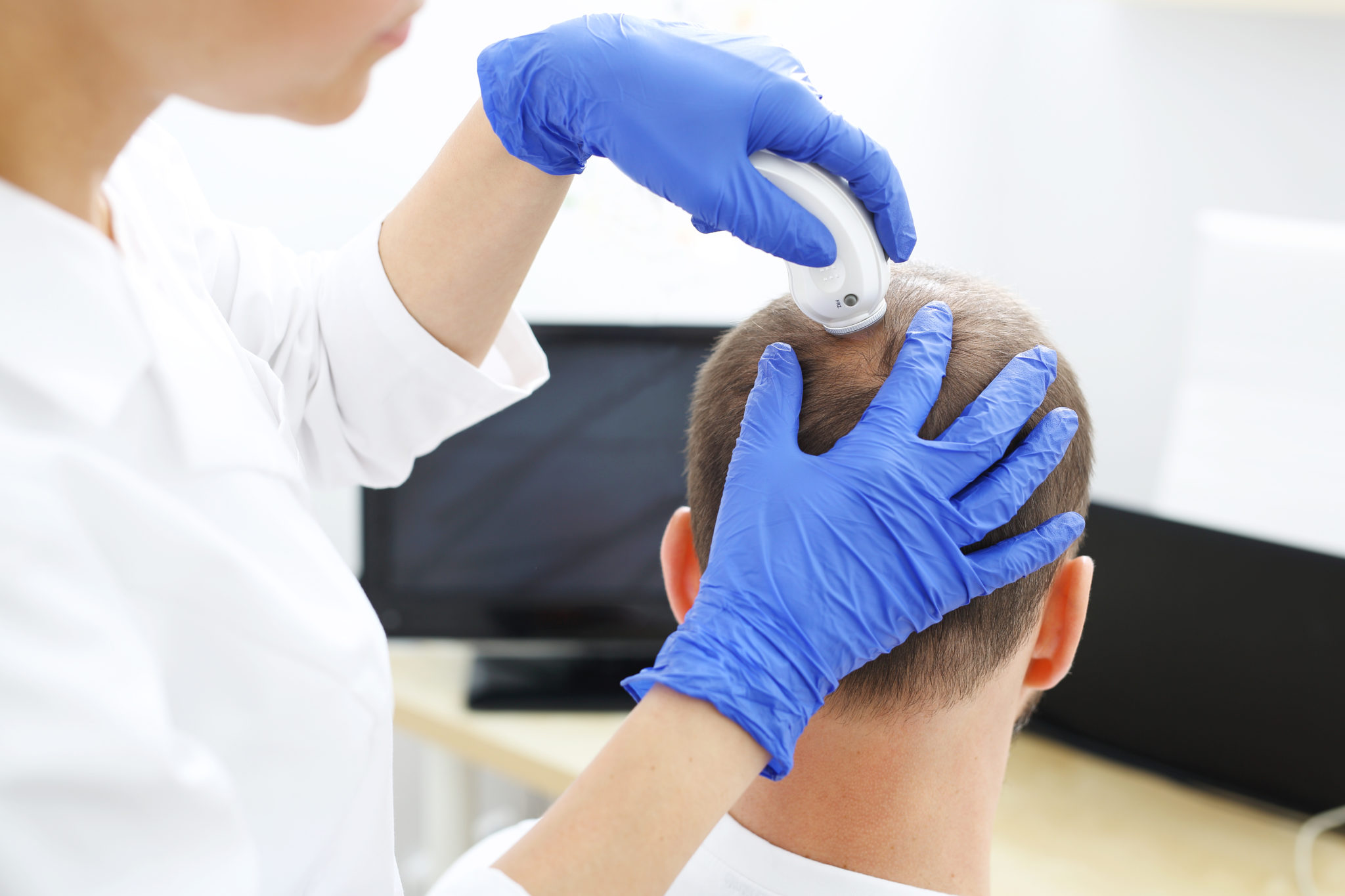 Scalp Analysis at Hair Transplant Malaysia