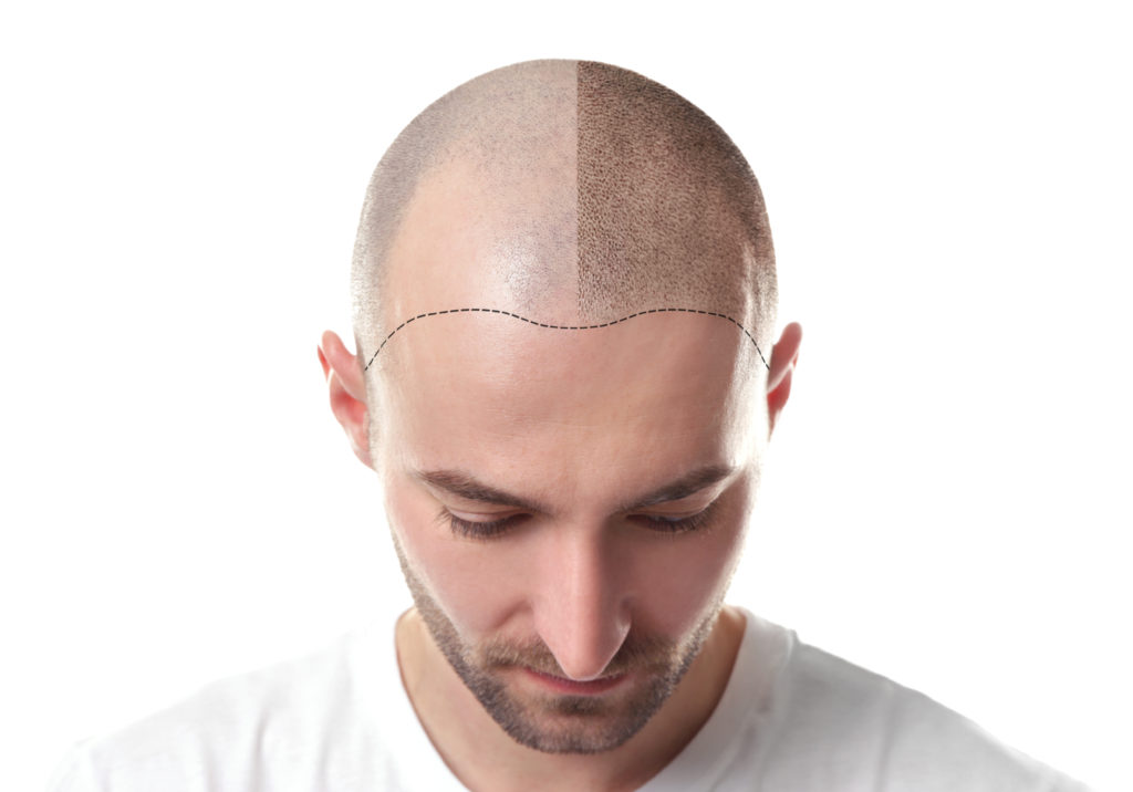 Hairline Design For Scalp Micro Pigmentation at Hair Transplant Malaysia