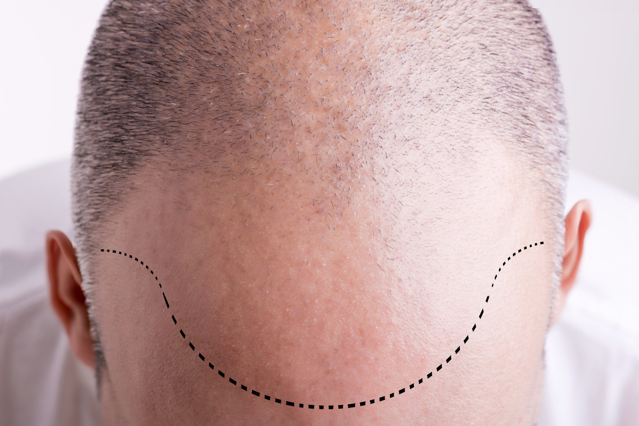 Hairline Design For Hair Transplant