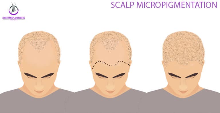 Scalp Micropigmentation Area