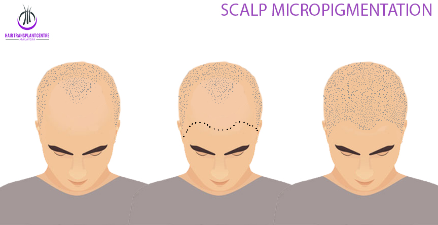 Scalp Micropigmentation Area