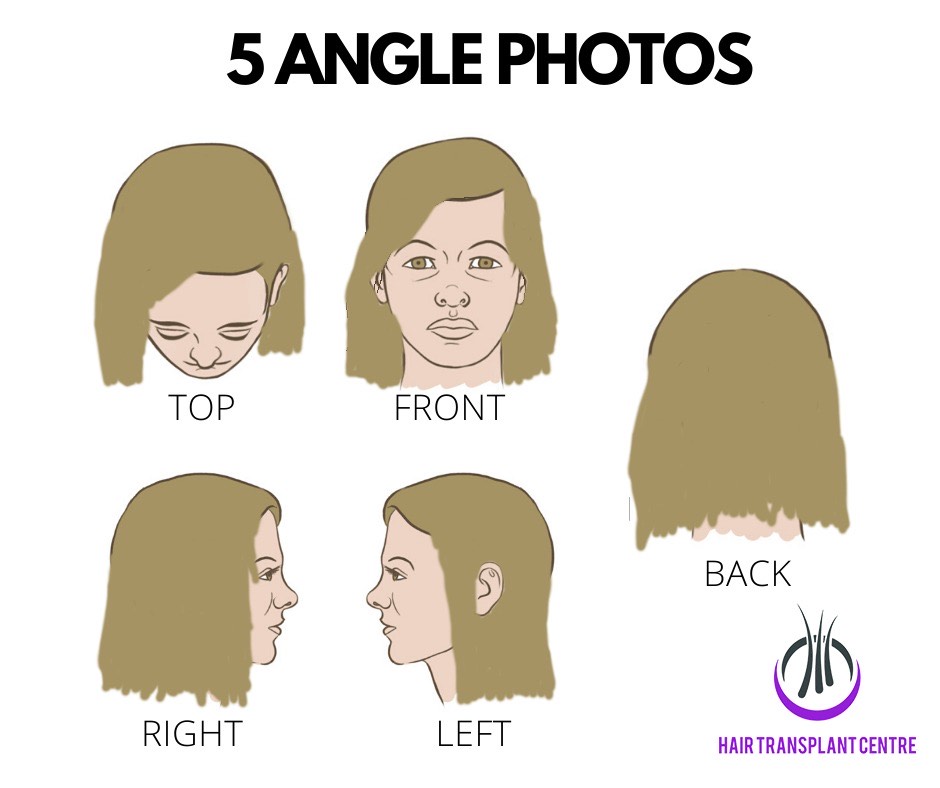 hair transplant female five angle photos
