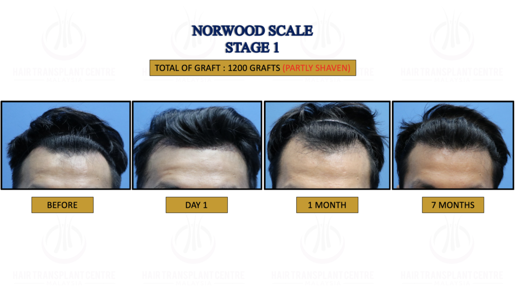 NORWOOD STAGE 1