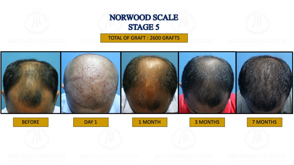 Norwood Stage 5 treatment