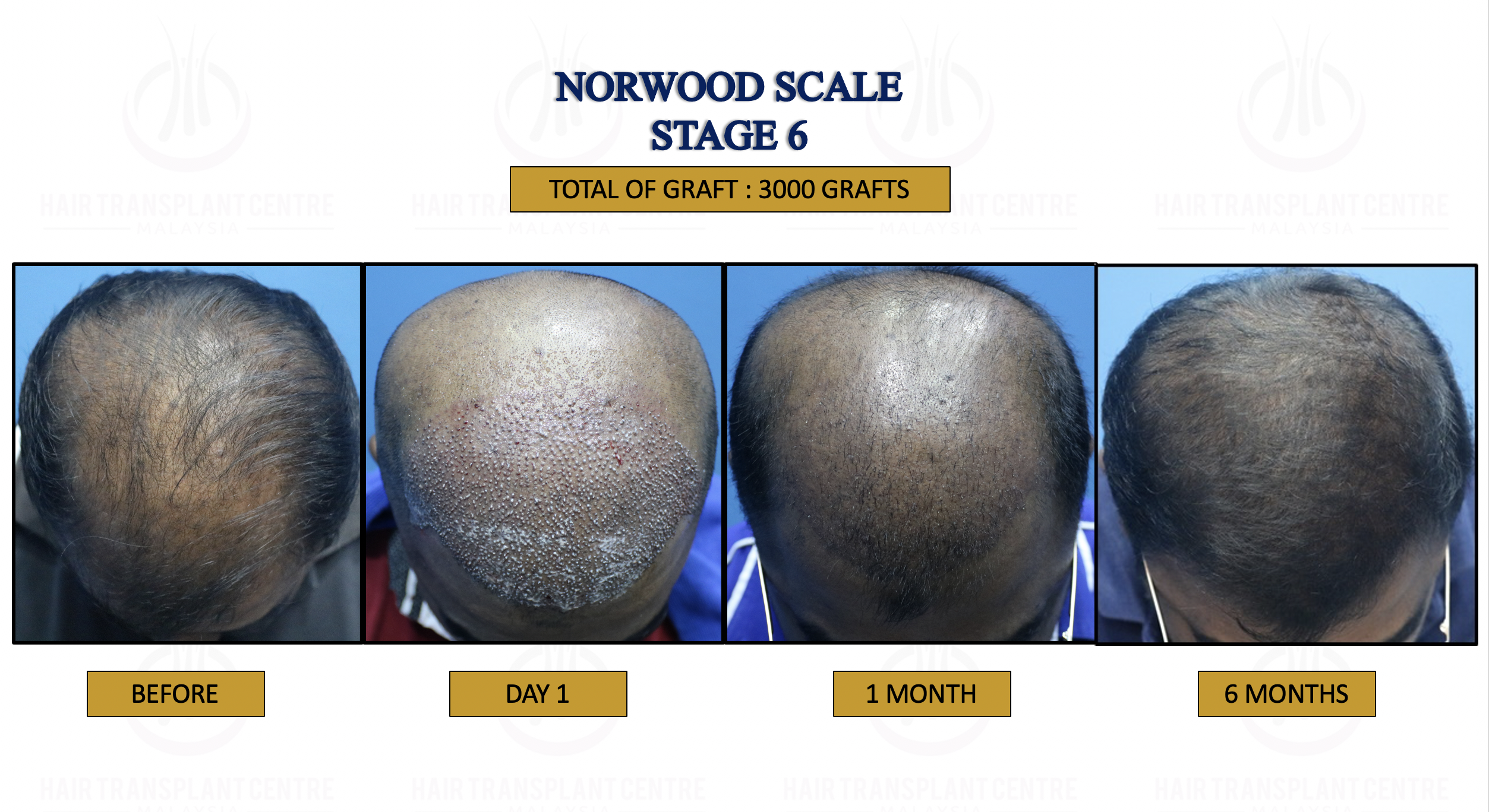 Norwood Scale Stage 6