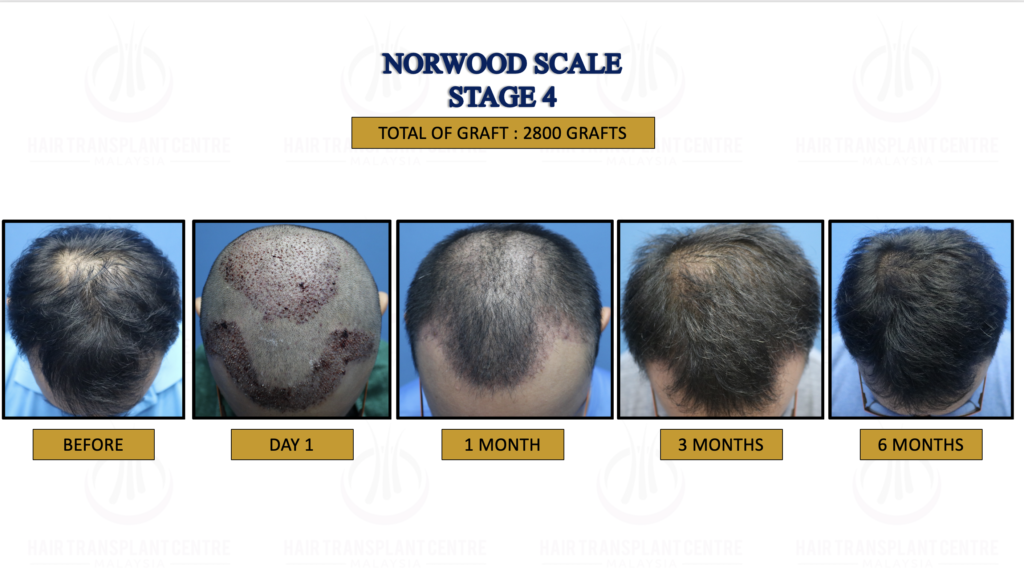 Stage 4 Norwood for Hair Transplant