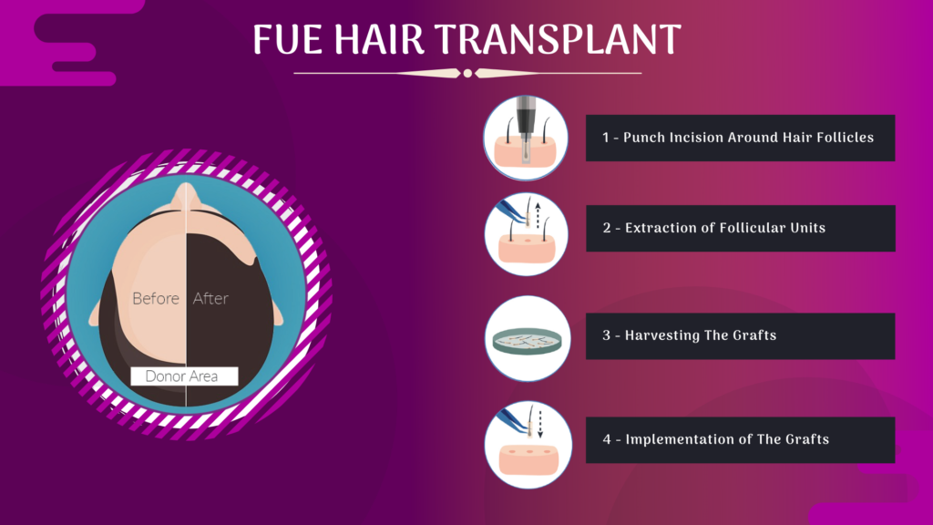 FUE Hair Transplant Li Ads | hairtransplantcentremalaysia.com