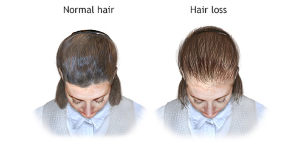 Female Hair Pattern