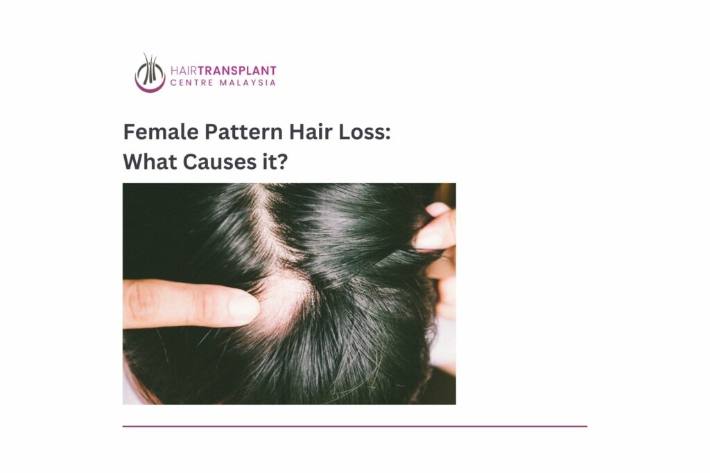 Female Pattern Hair Loss What Causes it