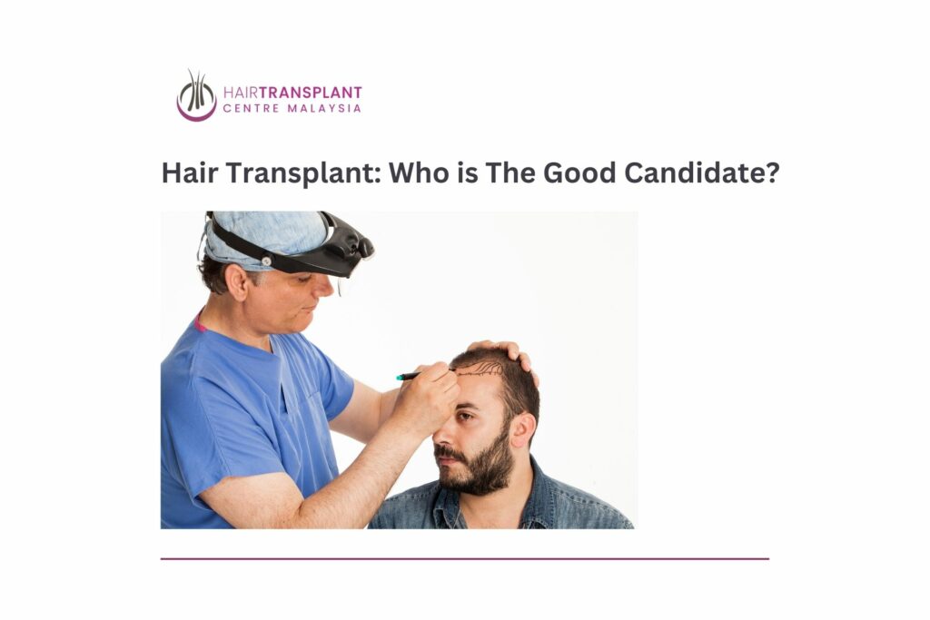 Hair Transplant Who is The Good Candidate