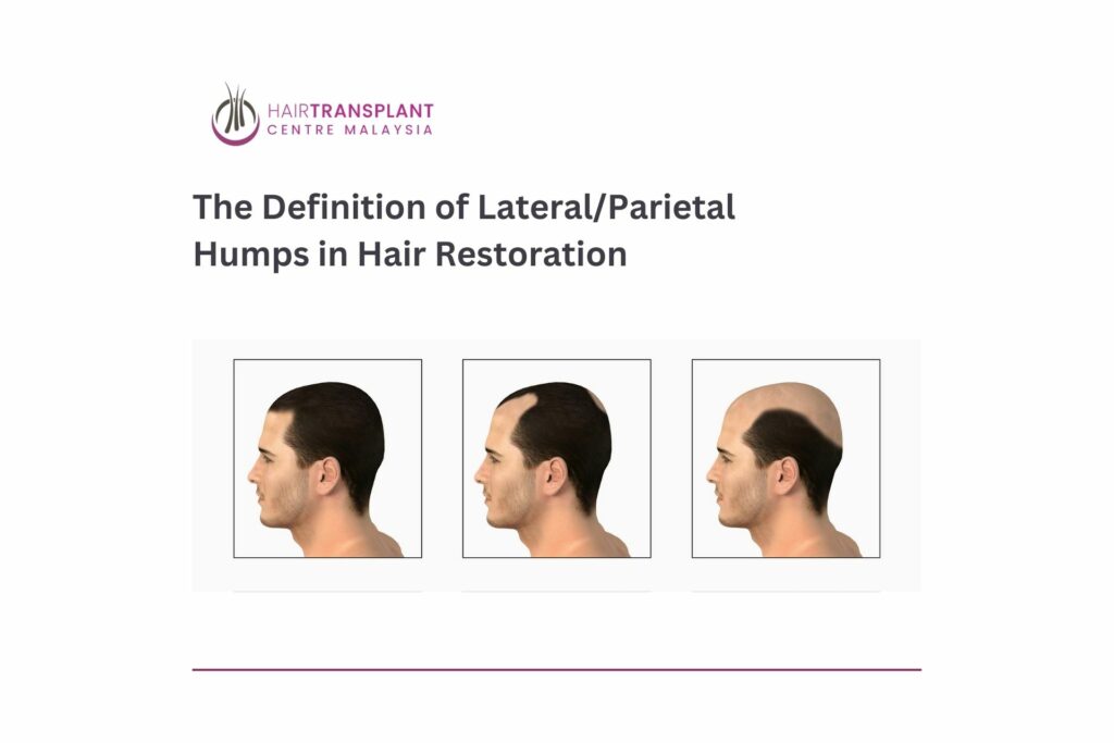 The Definition of Lateral Parietal Humps