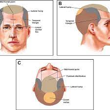 Lateral/Parietal Humps