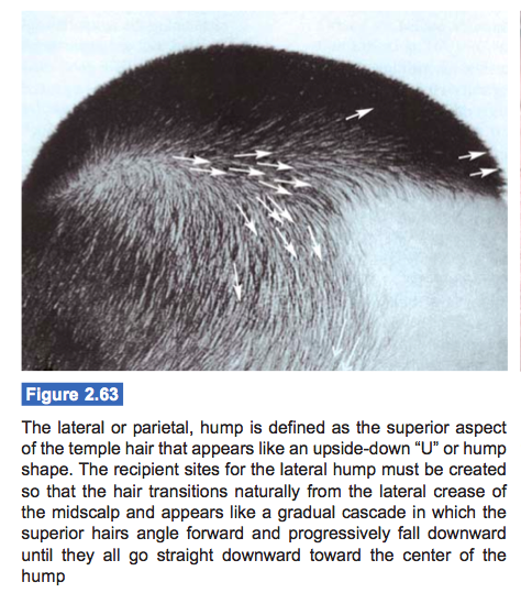 hair-transplant-lateral-humps