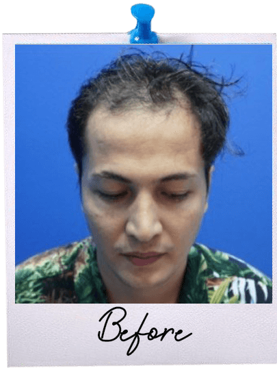 Hair Transplant centre malaysia - Before Hair Transplant image 112