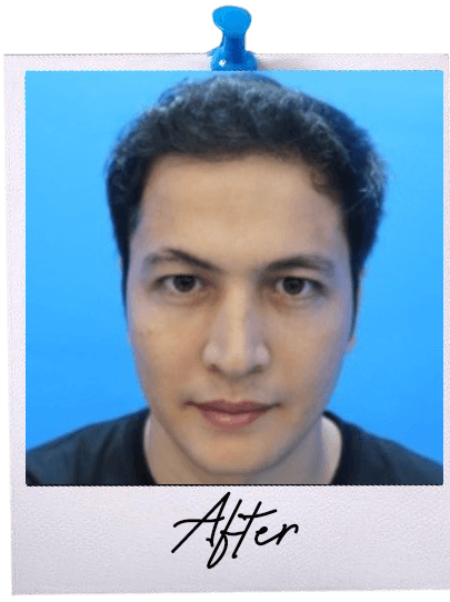 Hair Transplant centre malaysia - After Hair Transplant image 112