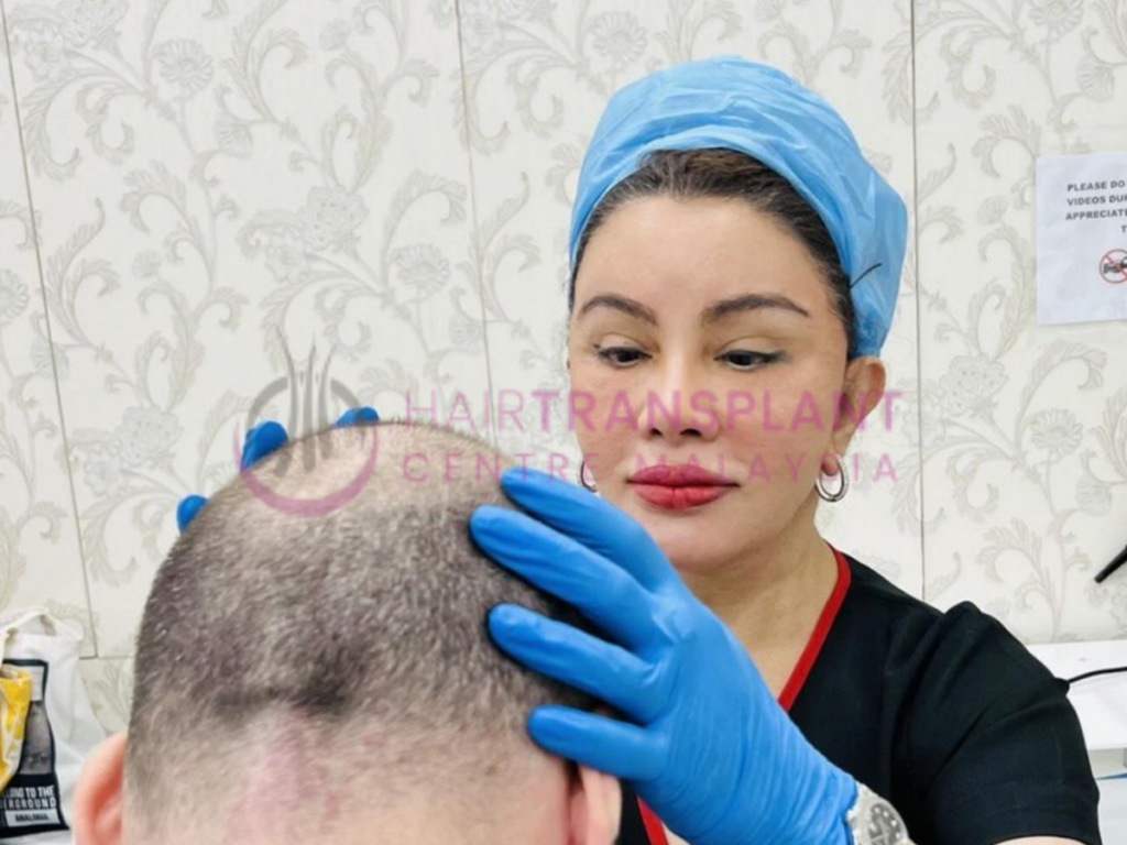 Hair Transplant Centre malaysia - 1 Week after Hair Transplant: Things to Know