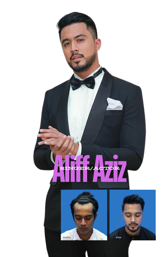 Hair Transplant Centre Malaysia - Aliff Aziz (Singer/Actor)