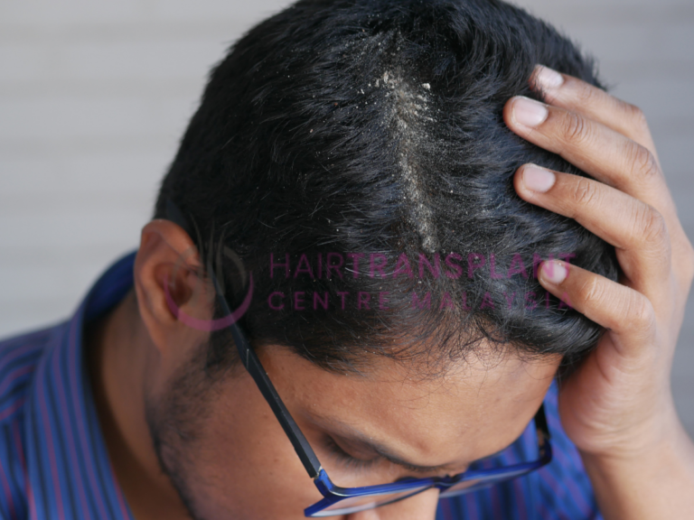 Can Dandruff Hinder the Growth of My Transplanted Hair