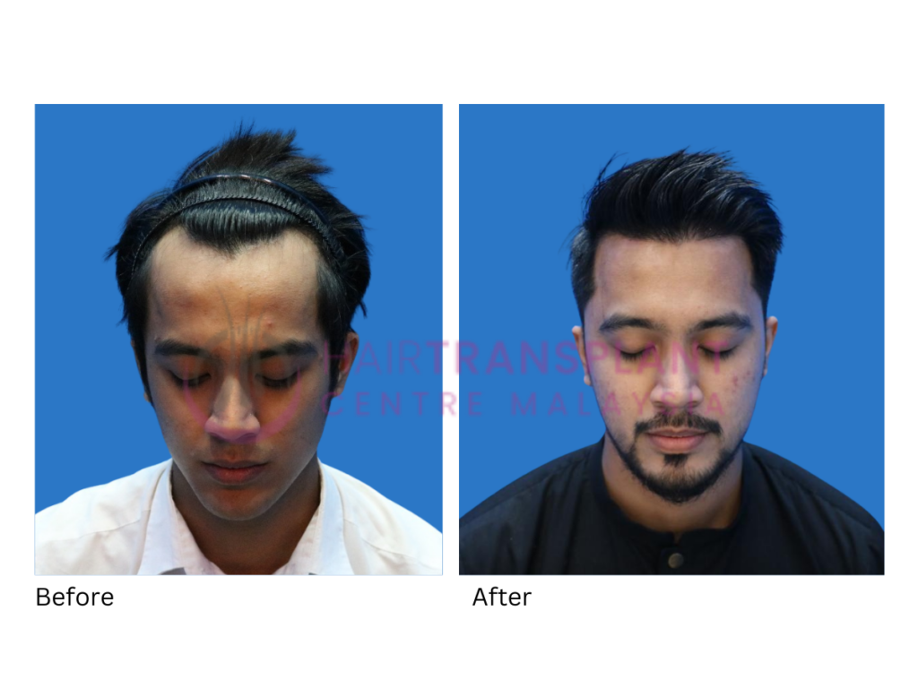 Hair Transplant centre malaysia - Aliff Aziz After Hair Transplant before after image