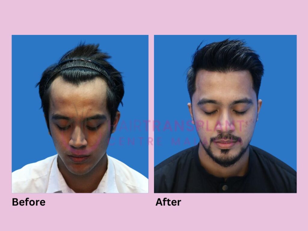 Hair Transplant centre malaysia - Aliff Aziz After Hair Transplant before after image