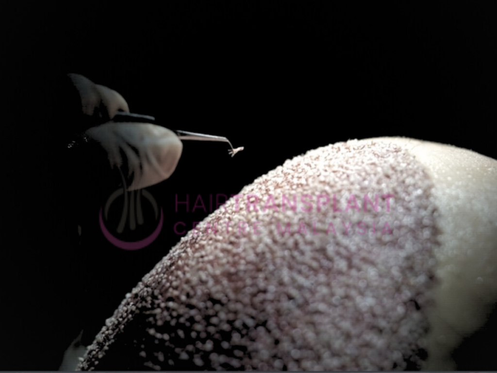 Hair Transplant Centre Malaysia - Hair Graft Placement