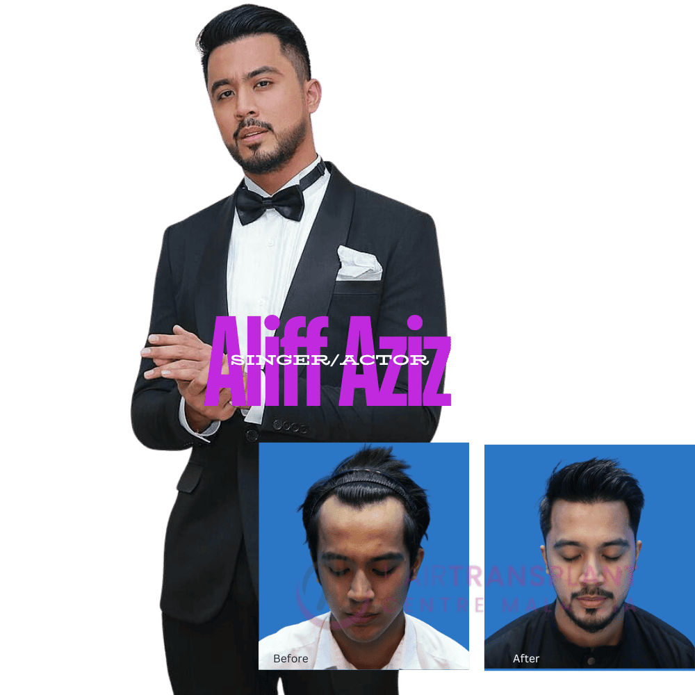 Hair Transplant Centre Malaysia - Aliff Aziz (3)