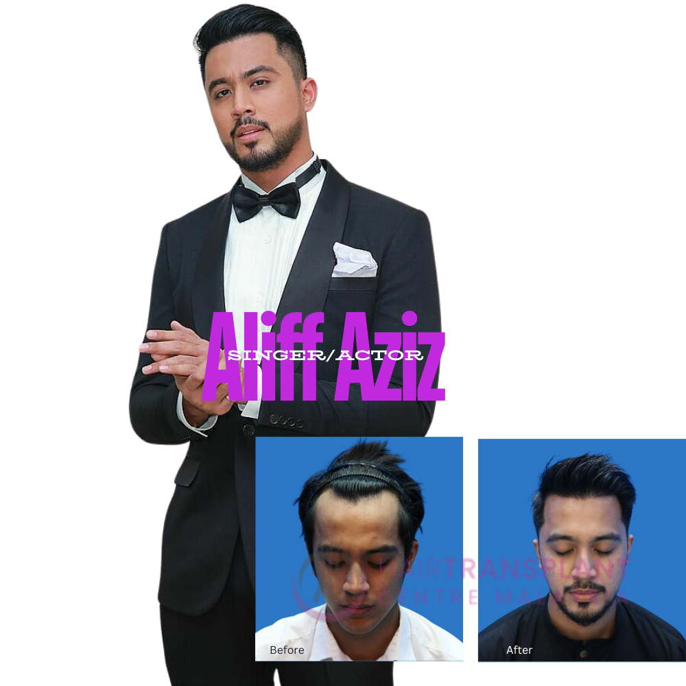 Hair Transplant Centre Malaysia - Hair Transplant - Aliff Aziz (Singer/Actor)