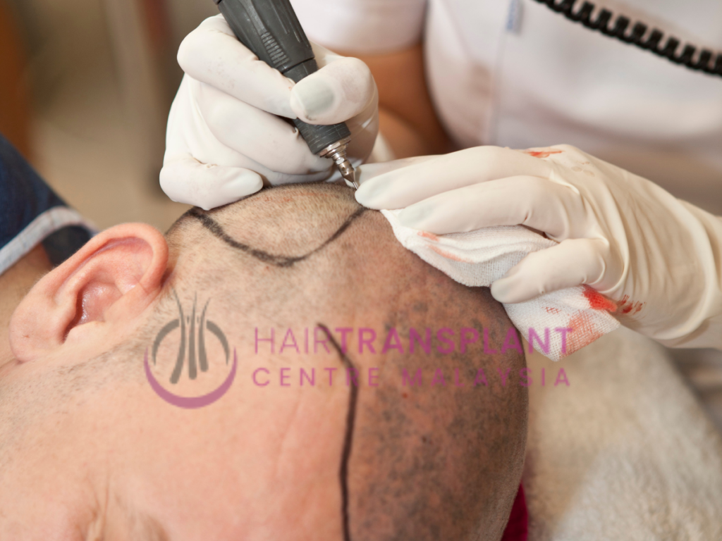 Hair Transplant Centre Malaysia - Follicle Extraction