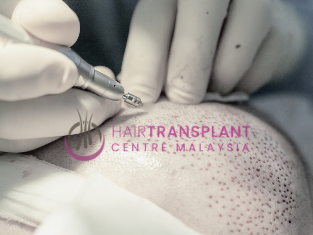 Hair Transplant Centre Malaysia - Recipient Site Creation