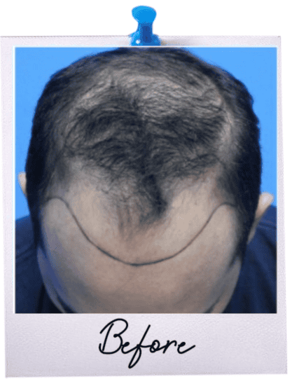 Hair Transplant Centre Malaysia - Before image