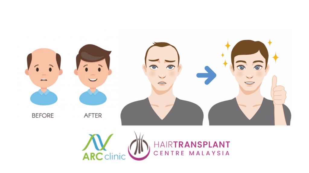 Benefits of Hair Transplant