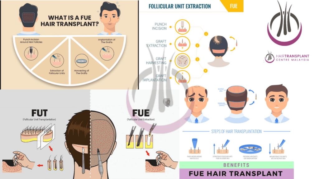 Benefits of Hair Transplant