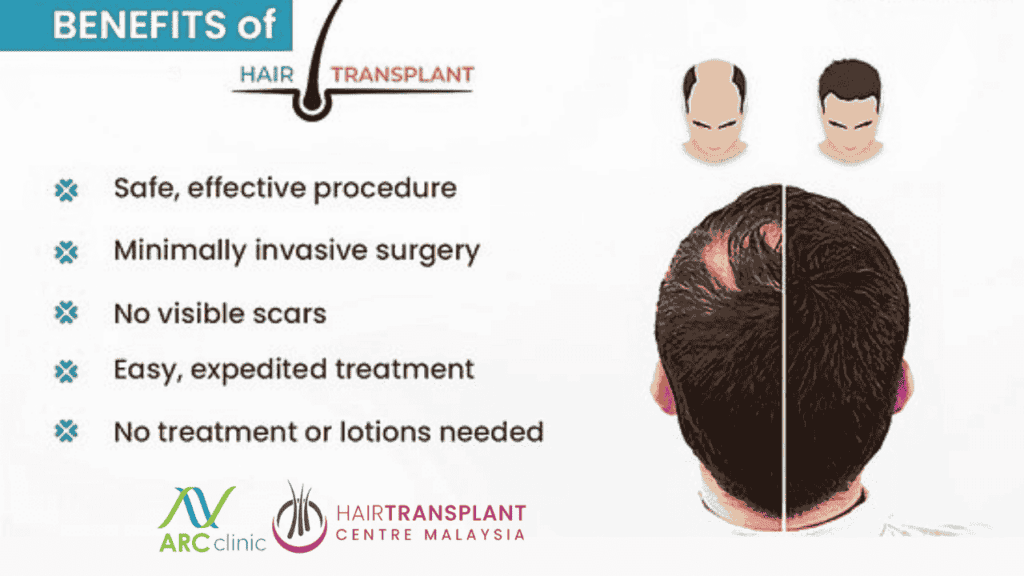 Benefits of Hair Transplant